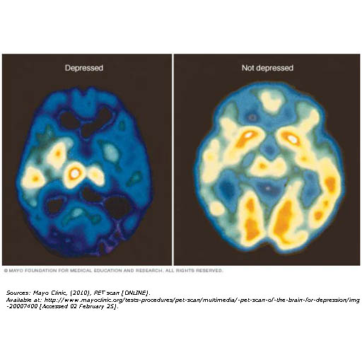 Image of normal and depressed brain.